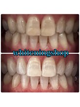 ホワイトニングショップ 鈴鹿店/Before&After美白ホワイトニング