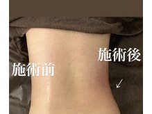 エックス シェイプ(X-shape)の雰囲気（ウエスト周りもハイパーナイフですっきり！）