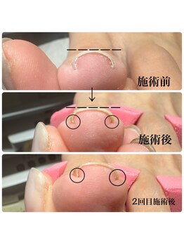 ヴェール(VERT)/巻き爪緩和