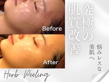 プレステージ 川崎店/ピーリング◆ビフォーアフター