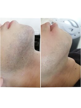 アロンドール リム(alondor rem)/ before/after @ひげ脱毛