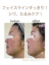 アルセ(arce)/エニシーグローパック