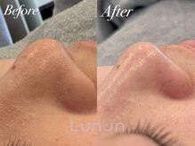 ルノン(Lunon)/毛穴洗浄ハイドロ