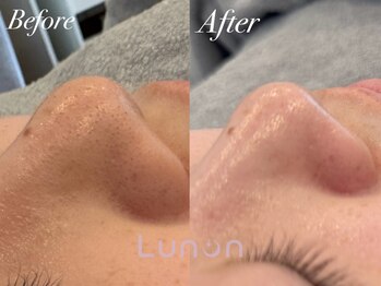 ルノン(Lunon)/毛穴洗浄ハイドロ