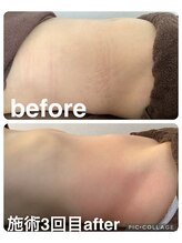 ギンザアール(GINZA R.)/ぽっこりお腹にアプローチ！