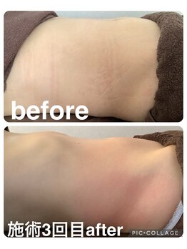 ギンザアール(GINZA R.)/ぽっこりお腹にアプローチ！