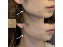 レミュー(remiu)/表情筋テラボーラー5回