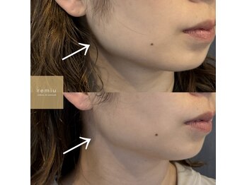 レミュー(remiu)/表情筋テラボーラー5回