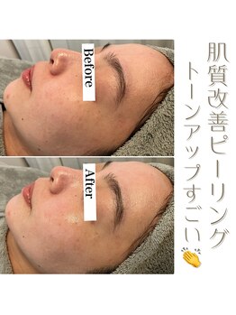 エヌプラス(N+)/30代女性＊ピーリング直後