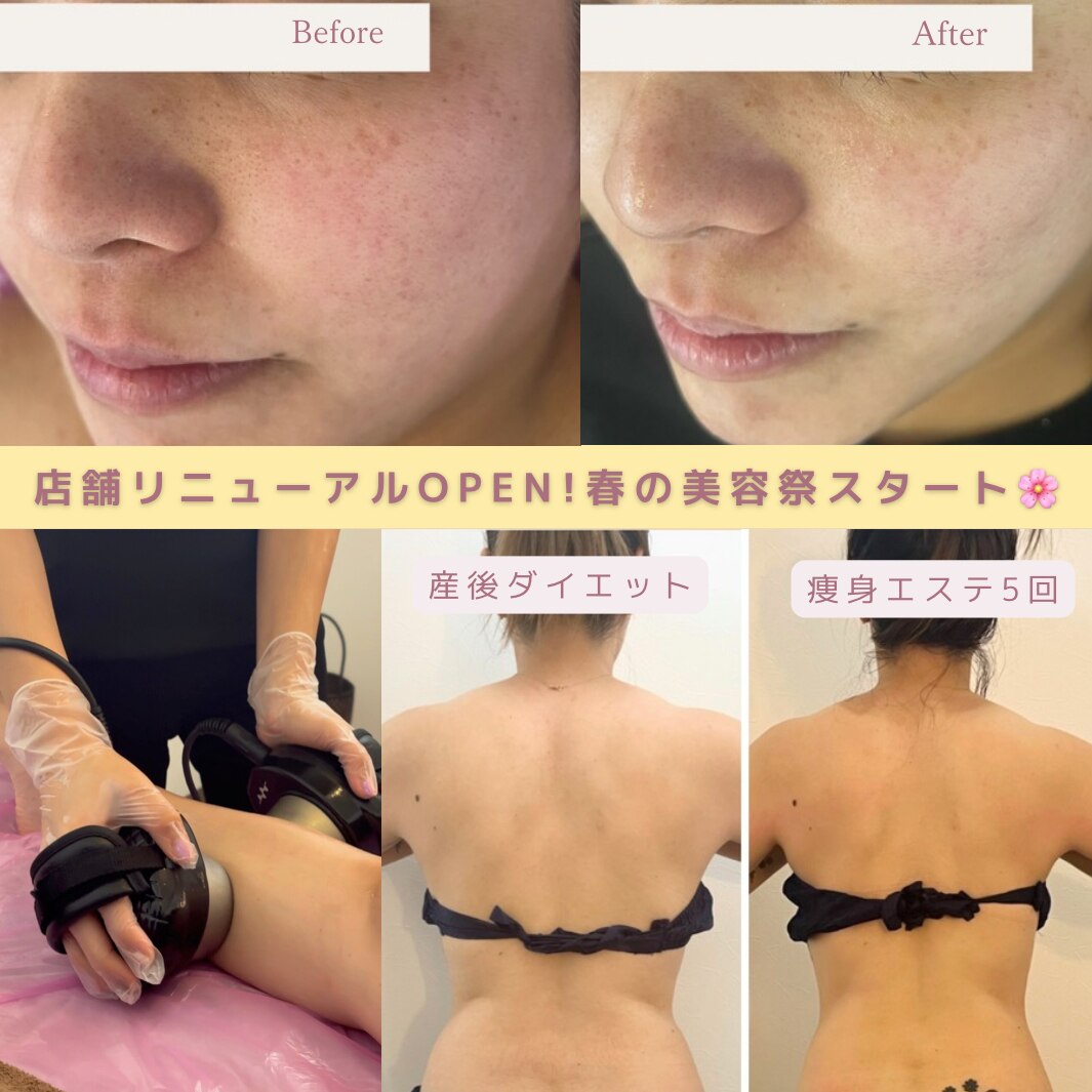 宜野湾市でキャビテーションが人気のエステサロン｜ホットペッパー