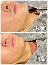 ワイズサロン(Y's salon)/ヒゲ脱毛９回終了