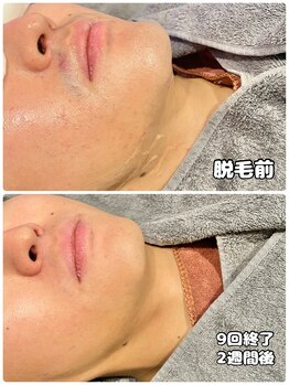 ワイズサロン(Y's salon)/ヒゲ脱毛9回終了