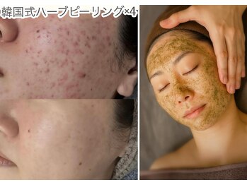 エルフ(elf)の写真/敏感肌OK！剥離あり【韓国式ハーブピーリング＋毛穴洗浄★90分￥8800】ザラツキ・赤み解消！赤ちゃん肌へ