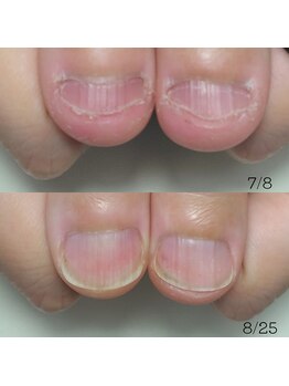 なかやまネイルクリニック/深爪矯正