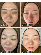 ナナラ(nanara)/マリムーブフェイシャルワックス