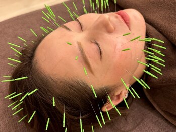 しんたろう鍼灸整骨院の写真/【口コミ多数×高評価】老廃物の排出を促進し、むくみ改善でリフトアップ効果◎たるみ・二重アゴ改善にも☆