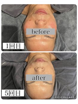 アンドココ(&coco)/ENVIRON トリートメント