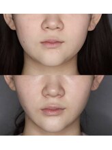 スムース イー(Smooth+E)/超音波リフトアップ