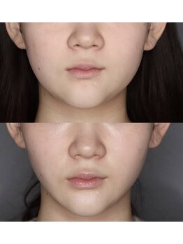 スムース イー(Smooth+E)/超音波リフトアップ