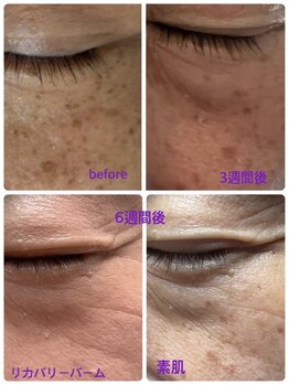 ヨウキ(YOKI)/シミケアにも効果抜群◎