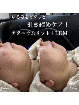 イロハ(IROHA)/施術前後◎