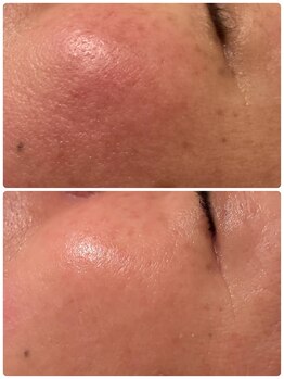 アロマセラピーサロン クオーレ(Cuore)/赤みが引き本来の健やかな肌へ