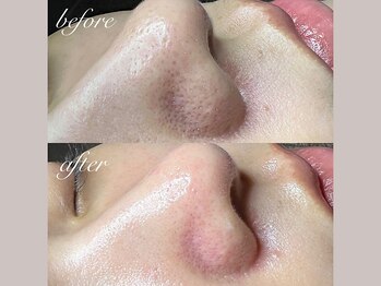 セリジェ 青山(Cerisier)/毛穴施術の後はしっかり引き締め