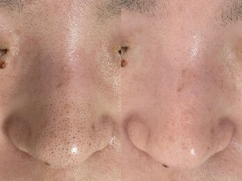 アルカンシエル(arcenciel)の写真/黒ずみ・角栓も、気になる毛穴の開きも。ざらつきや凹凸をケアして、つるんとなめらかな素肌へ。
