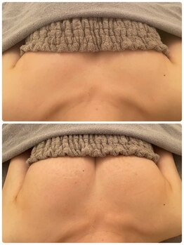 美人バスト 浜松店/◆バストアップ BeforeAfter◆