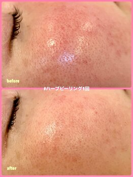 ミレボ(Me.rebo)/ハーブピーリング1回のB→A