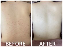 ハーブピーリング 恵比寿/ハーブピーリング背中ニキビケア