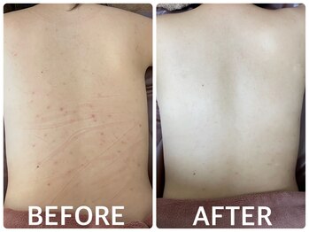 ハーブピーリング 恵比寿/ハーブピーリング背中ニキビケア