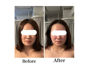 ハリムーン 仙台(harimoon)/美容鍼ビフォーアフター