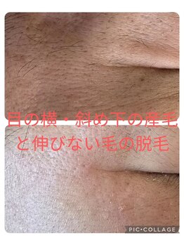 ベビースキン(baby skin)/美容電気脱毛