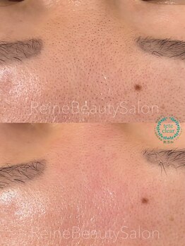 レーヌ(Reine)/毛穴エクストラクション