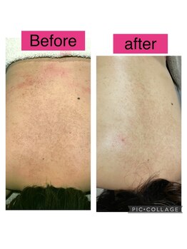 インチャント(enchant)/背中のニキビケア・黒ずみケア