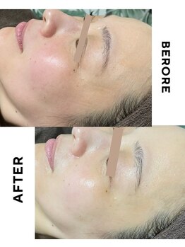 ゼロ 水戸店(ZERO)/シミ・シワ肌質改善スペシャル