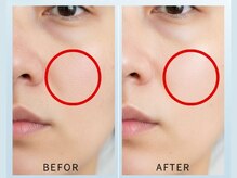 毛穴洗浄1回のビフォーアフターです♪