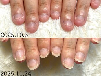 深爪矯正 爪悩み専門店 グラシナ 西宮北口店【4/3 NEW OPEN（予定）】/(深爪/長さだし/フィルイン)