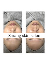 Sarang skin salon/川西｜水光肌ケア