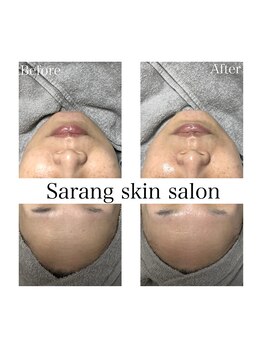 Sarang skin salon/川西｜水光肌ケア