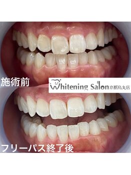 ホワイトニングサロン 京都烏丸店/ホワイトニング施術例