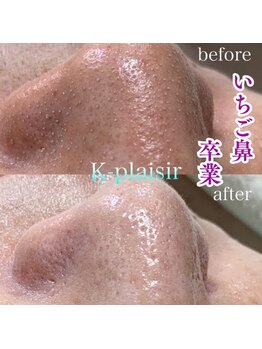 ケイ プレジール/【大阪・本町】いちご鼻毛穴洗浄