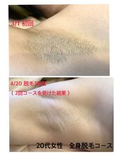 サニーハンド(Sunnyhand)/効果実感の速い信頼脱毛！！