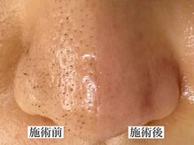 エミナル(eminal)/ビフォー/アフター/毛穴/梅田