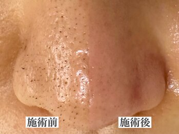 エミナル(eminal)/ビフォー/アフター/毛穴/梅田