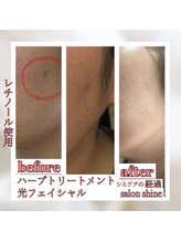 サロンシャイン(Salon Shine)/お肌の経過レチノール使用