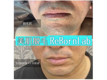 リボーンラボ(ReBorn Lab)/ヒゲ脱毛2回目BeforeAfter