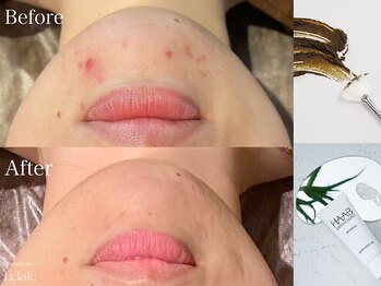 サロンドエクラル(Salon de Eclale wax)/ハーブリプロ肌質改善