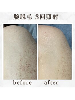 ボゴス(BOGOSS)/腕脱毛3回照射